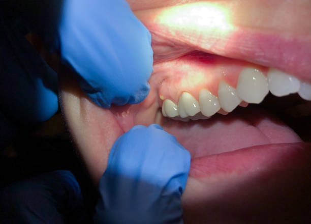 Best Urgent Care for Lost Fillings or Crowns in Desert Palms, CA